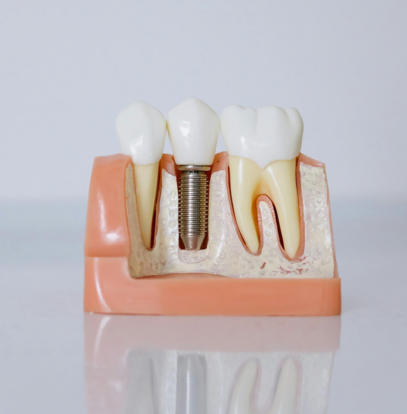 Detailed view of a dental implant model showcasing teeth and gum anatomy for dental education.